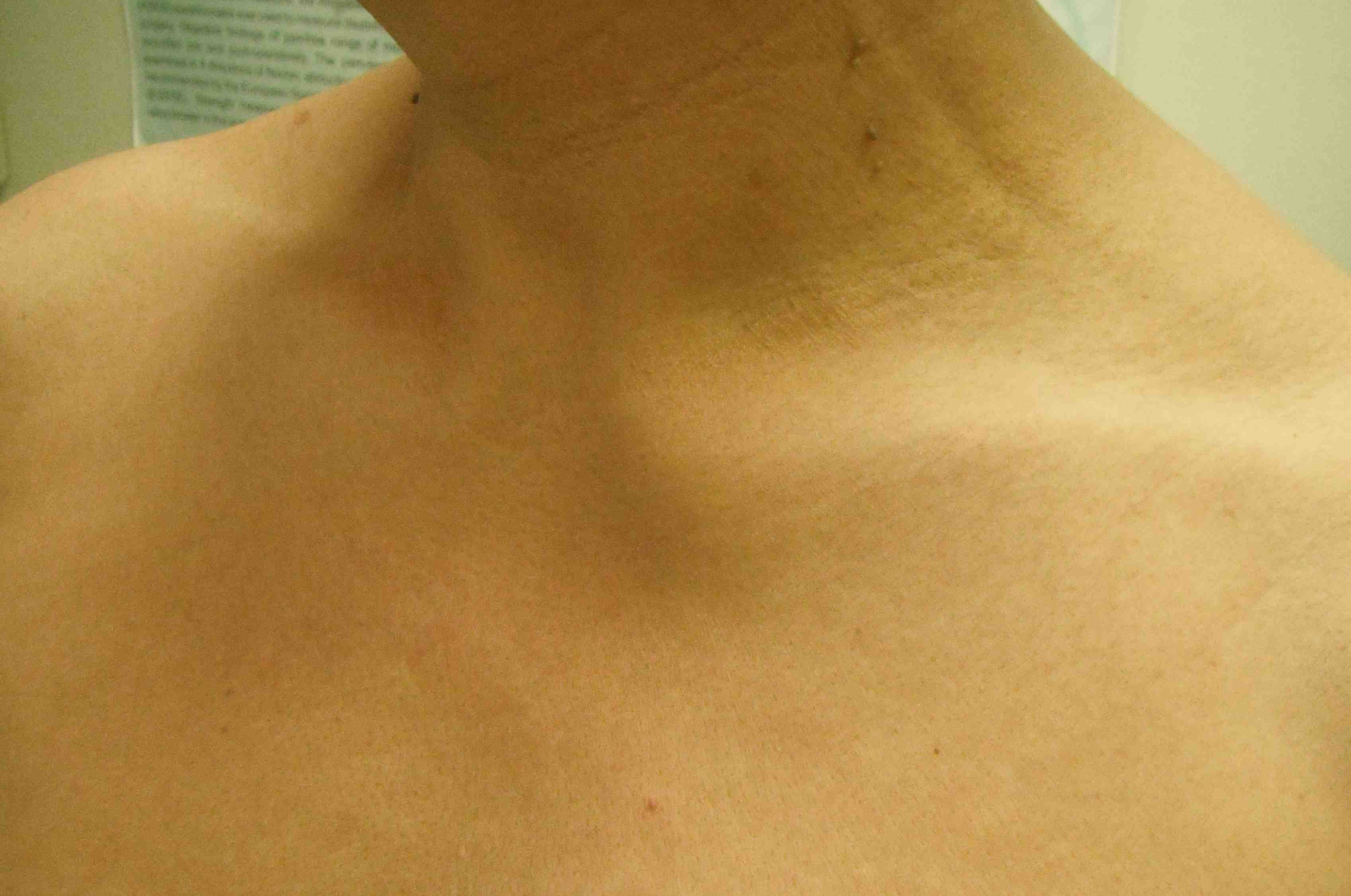 Sternoclavicular Anterior Dislocation